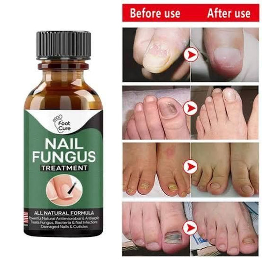 Nail Fungus Treatment – 10ml