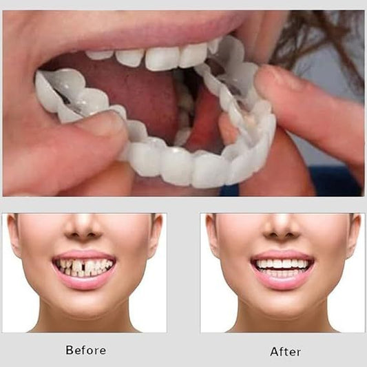 Snap-On Smile Veneers – Moldable False Teeth Kit for Men & Women